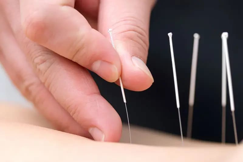 Clinical Acupuncture